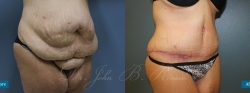 abdominoplasty_patient01_02