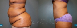 abdominoplasty_patient02_05