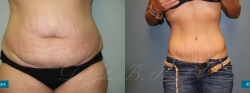 abdominoplasty_patient03_02