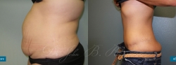 abdominoplasty_patient03_05