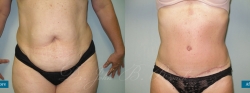 abdominoplasty_patient04_02