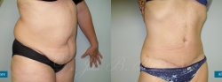 abdominoplasty_patient04_04