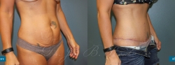 abdominoplasty_patient06_02