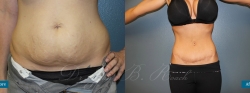 abdominoplasty_patient07_02