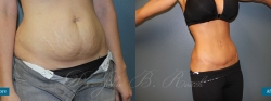 abdominoplasty_patient07_03