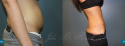 abdominoplasty_patient07_04