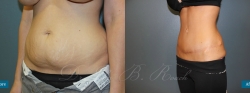 abdominoplasty_patient07_05