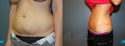 abdominoplasty_patient07_06