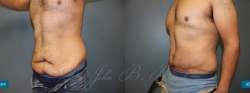 abdominoplasty_patient08_04
