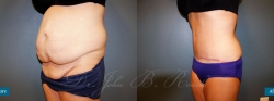 abdominoplasty_patient09_04
