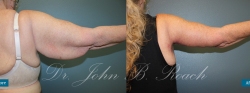 Brachioplasty Arm Lift