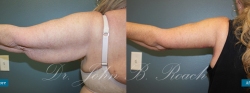 Brachioplasty Arm Lift