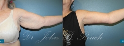 Brachioplasty Arm Lift