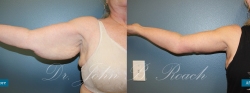 Brachioplasty Arm Lift