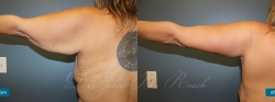 brachioplasty_patient01_01
