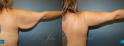 brachioplasty_patient01_02