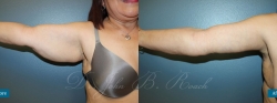 brachioplasty_patient02_01
