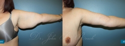 brachioplasty_patient02_02
