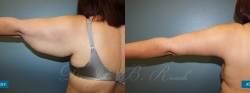 brachioplasty_patient02_03