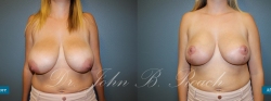 Breast reduction and lift