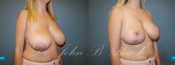 Breast reduction and lift