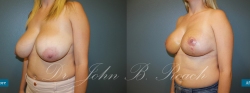 Breast reduction and lift