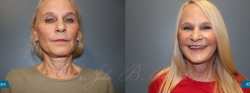 facelift_patient02_01