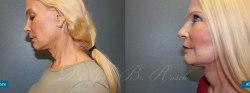 facelift_patient02_06