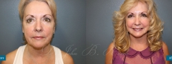facelift_patient03_01