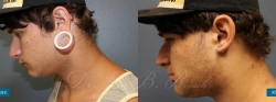otoplasty_patient01_01